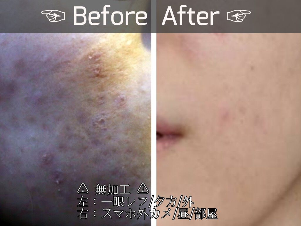 薬用しみ対策 保湿クリーム/メラノCC/フェイスクリームを使ったクチコミ（3枚目）