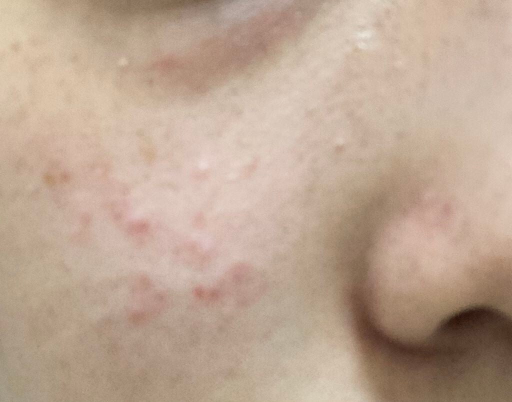 fresh_lips_jkd1 on LIPS 「とても汚い肌をお見せしてしまい申し訳ありません(--;)ニキビ..」(3枚目)