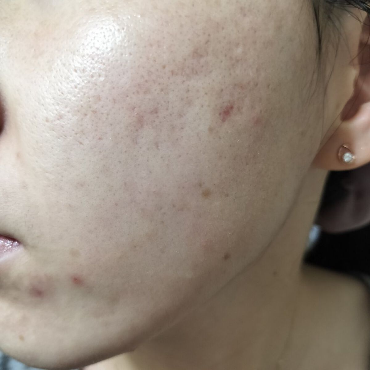 Glucolic Acid 30% Gel Peel/YEOUTH/ピーリングを使ったクチコミ（2枚目）