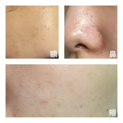 ミミ on LIPS 「【私の肌は1週間でどこまで変われるのか】夏のスキンケアをサボっ..」(8枚目)