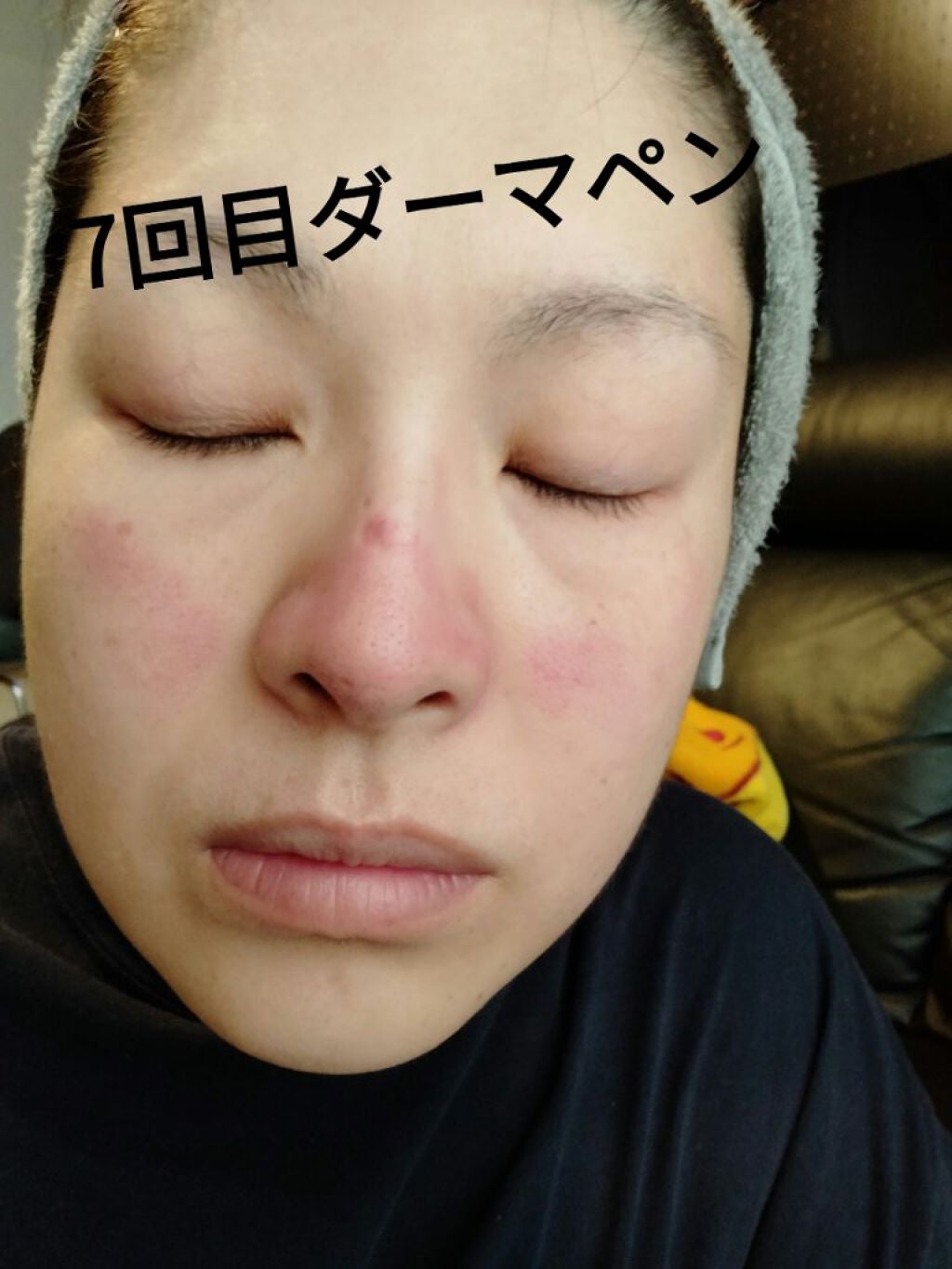 ダーマペン・ダーマスタンプ/MyM/その他スキンケアグッズを使ったクチコミ(1枚目)