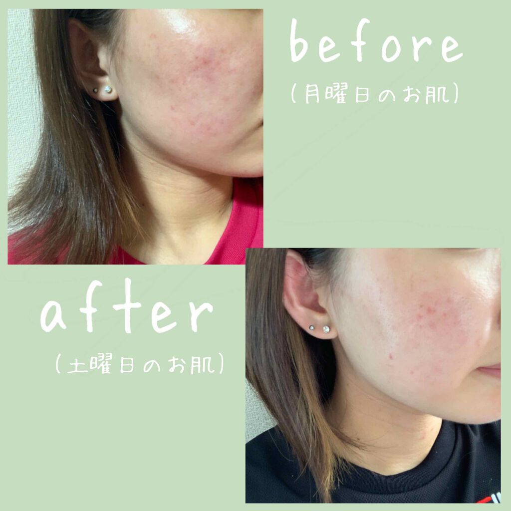 オードムーゲ 薬用ローション（ふきとり化粧水）/オードムーゲ/拭き取り化粧水を使ったクチコミ（3枚目）