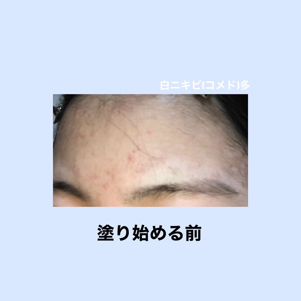 soa on LIPS 「⚠️至急⚠️べピオゲルの副作用に関する相談です!白ニキビが気に..」(3枚目)