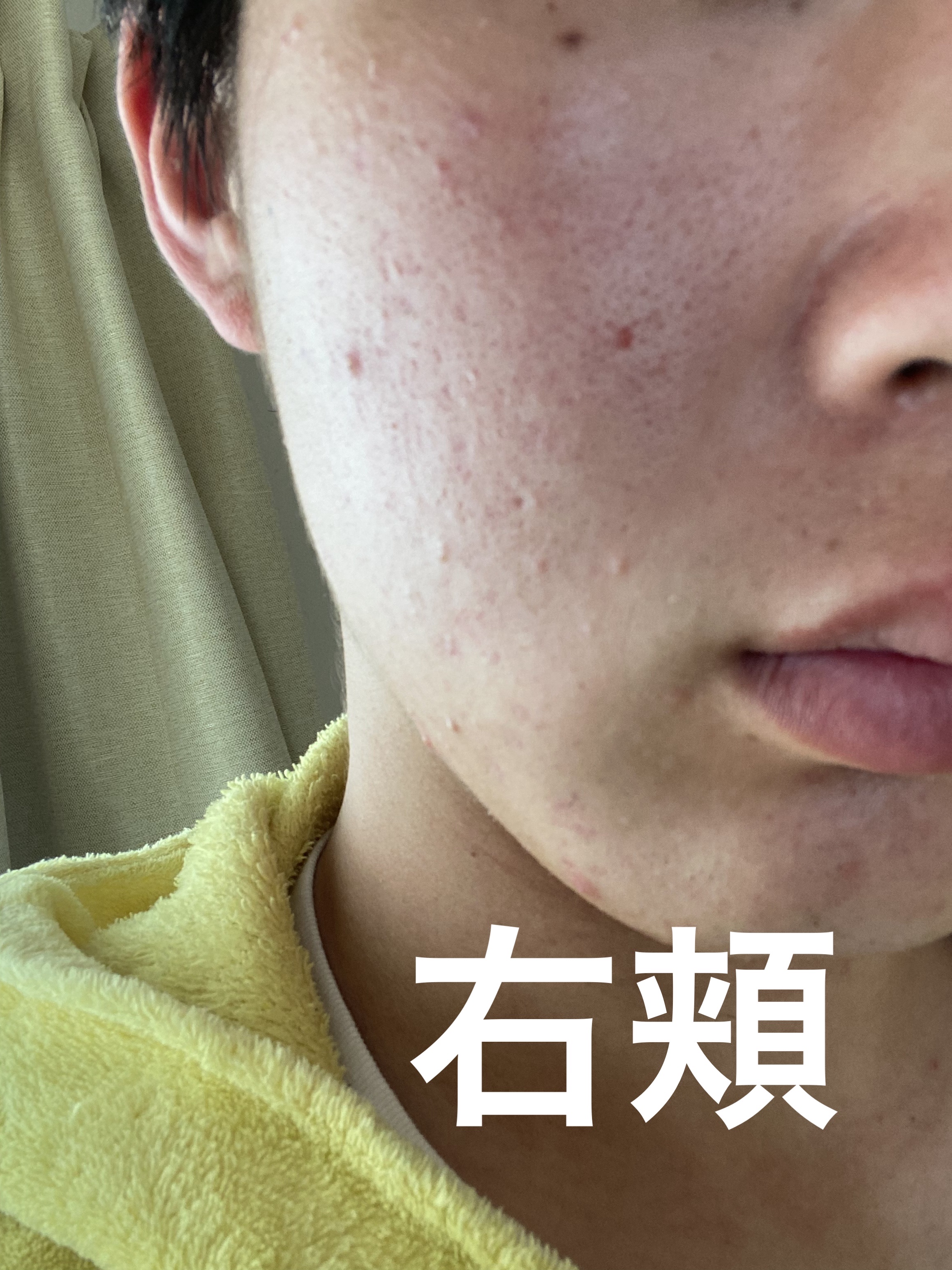 オルビス クリアフル ウォッシュのクチコミ「肌荒れ日記　1日目

今日から毎日できるかわからないけど自分の肌を投稿していきたいと思います。.....」（3枚目）