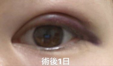 coral_beauty_lxtu on LIPS 「二重整形を考えている方へ👀✨埋没手術を受けてみた感想！私が受け..」（1枚目）