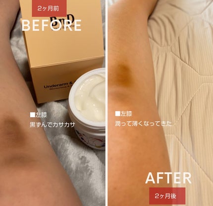 BnDアンダーアームクリーム(ボディクリーム)/BnD/デリケートゾーンケアを使ったクチコミ(5枚目)