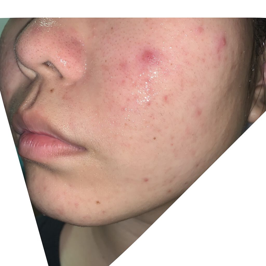 薬用しみ対策 美白化粧水/メラノCC/化粧水を使ったクチコミ（3枚目）