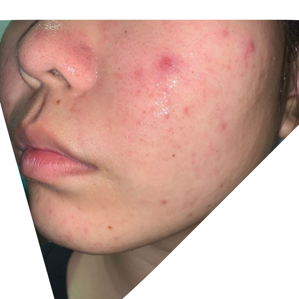 薬用しみ対策 美白化粧水/メラノCC/化粧水を使ったクチコミ(3枚目)