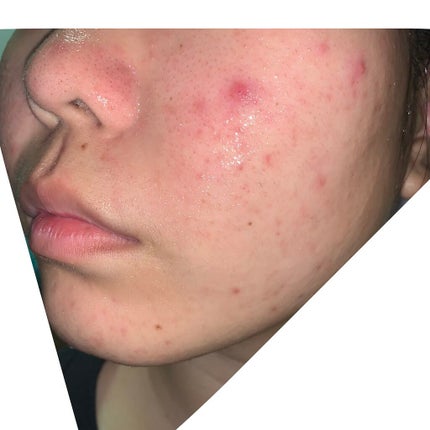 薬用しみ対策 美白化粧水/メラノCC/化粧水を使ったクチコミ(3枚目)