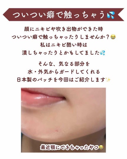 ゼロスポットパッチ/Today’s Cosme/にきびパッチを使ったクチコミ(2枚目)