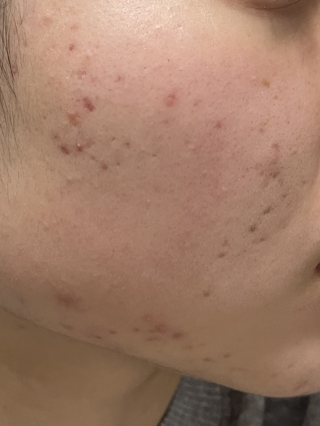 ペアアクネクリームW(医薬品)/ペア/その他を使ったクチコミ（2枚目）