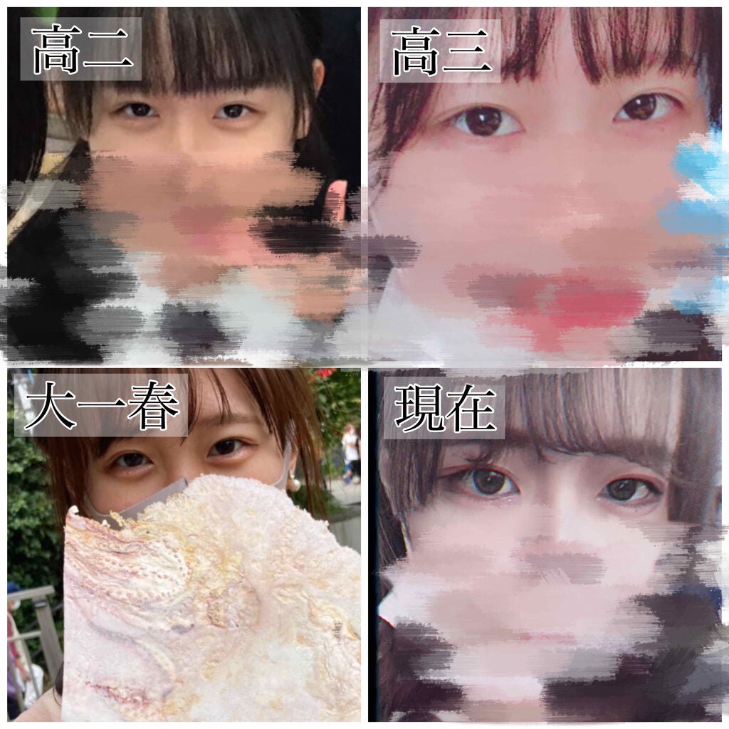 rim on LIPS 「私の二重についてこんにちは!初投稿させて頂きます!私の二重遍歴..」(3枚目)