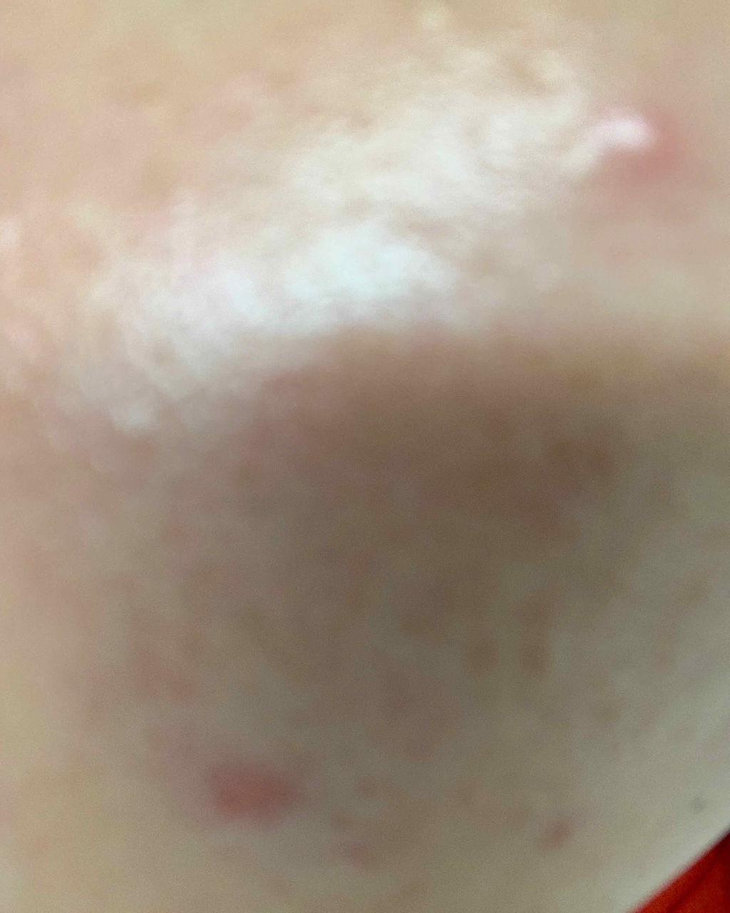 エピデュオゲル/マルホ株式会社/その他を使ったクチコミ（1枚目）