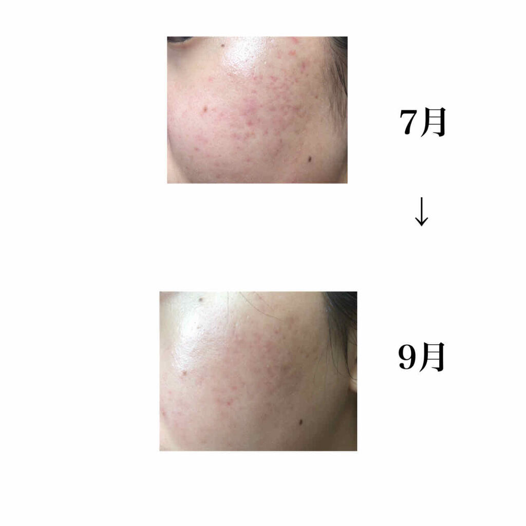 N10+Z1フェイスセラム /The Ordinary/美容液を使ったクチコミ（2枚目）