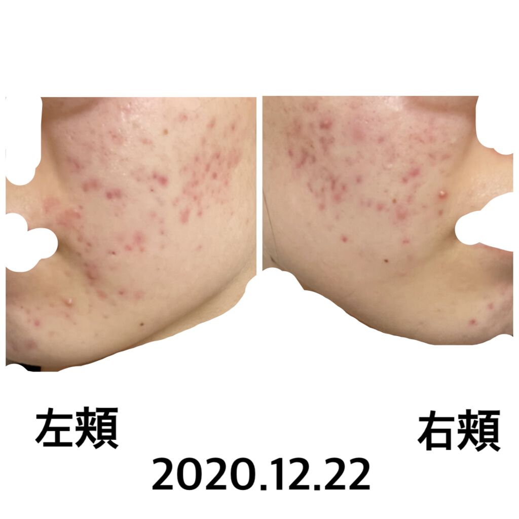 敏感肌用薬用美白美容液/無印良品/美容液を使ったクチコミ（1枚目）