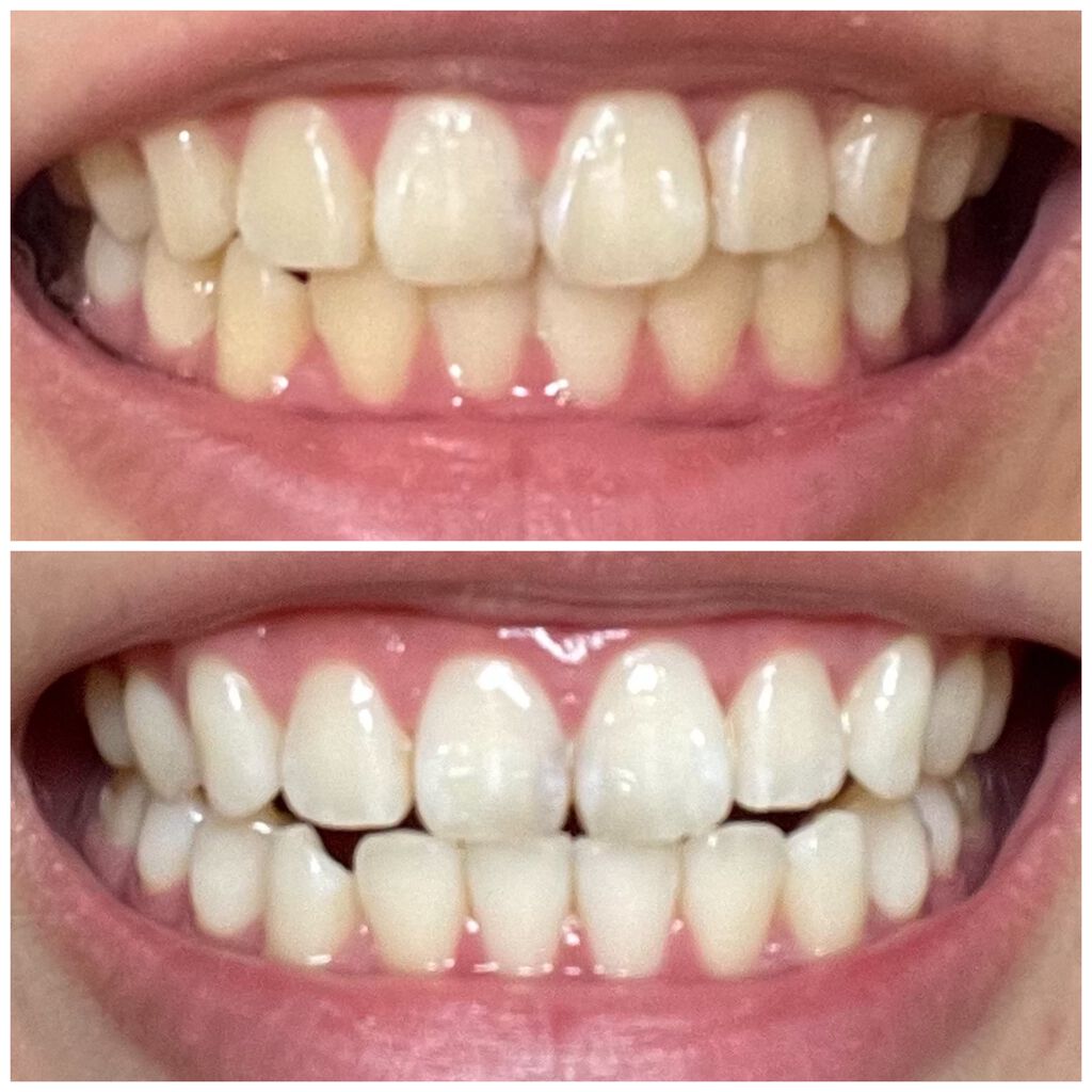 クレスト 3D ホワイトブリリアンス/クレスト/その他オーラルケアを使ったクチコミ(1枚目)