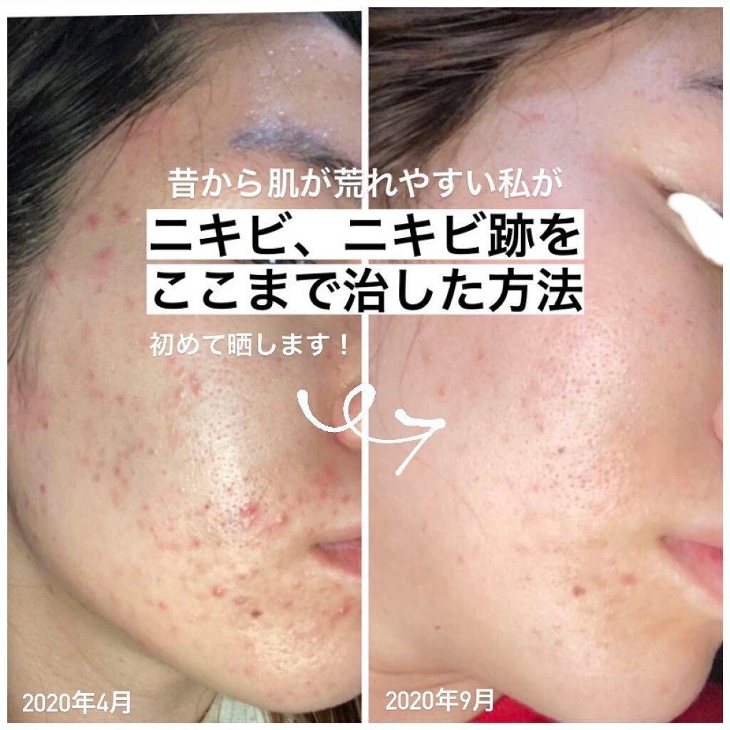 薬用 しみ 集中対策 美容液/メラノCC/美容液を使ったクチコミ(1枚目)