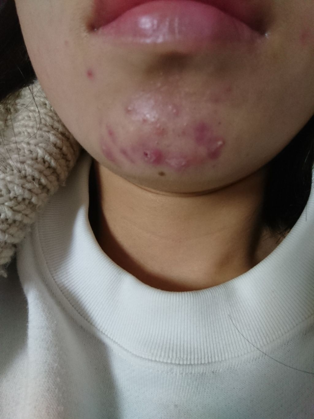 薬用 しみ 集中対策 美容液/メラノCC/美容液を使ったクチコミ（2枚目）