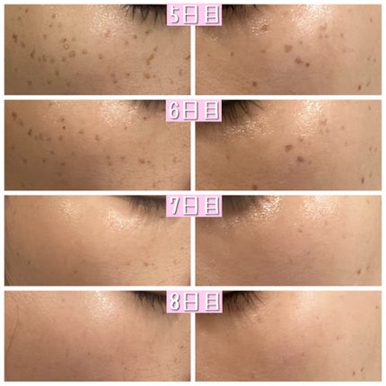 スキンブライセラム/ZO Skin Health/美容液を使ったクチコミ(3枚目)