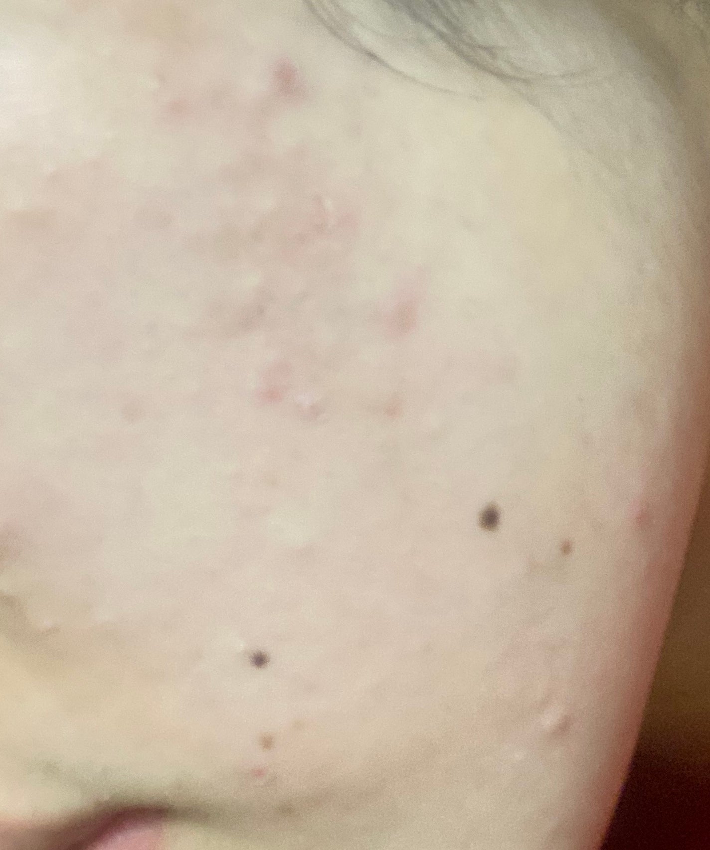 シカレチA クリーム0.05/VT/フェイスクリームを使ったクチコミ(4枚目)