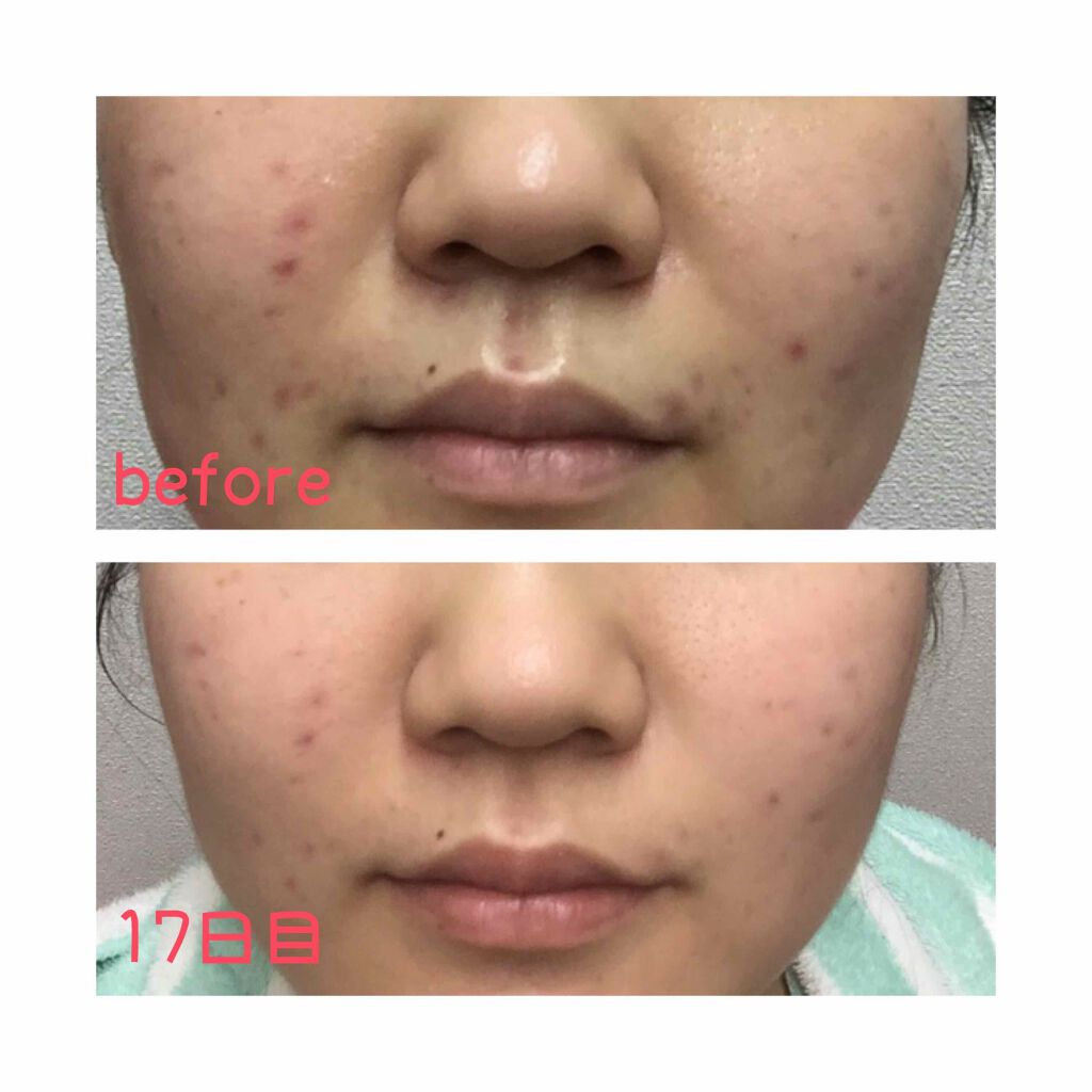 オールキルクリーム/APLIN/フェイスクリームを使ったクチコミ（2枚目）