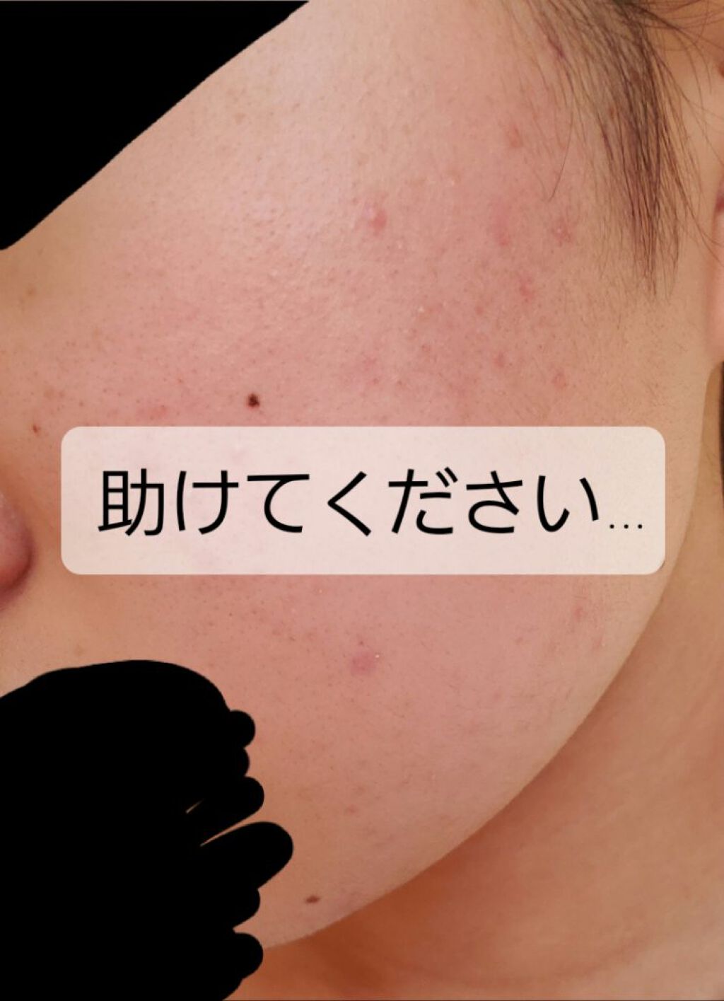 オードムーゲ 薬用ローション（ふきとり化粧水）/オードムーゲ/拭き取り化粧水を使ったクチコミ（1枚目）