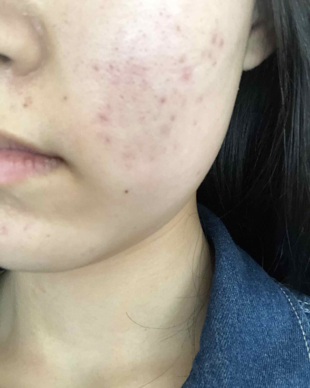 ペアアクネクリームW(医薬品)/ペア/その他を使ったクチコミ（3枚目）