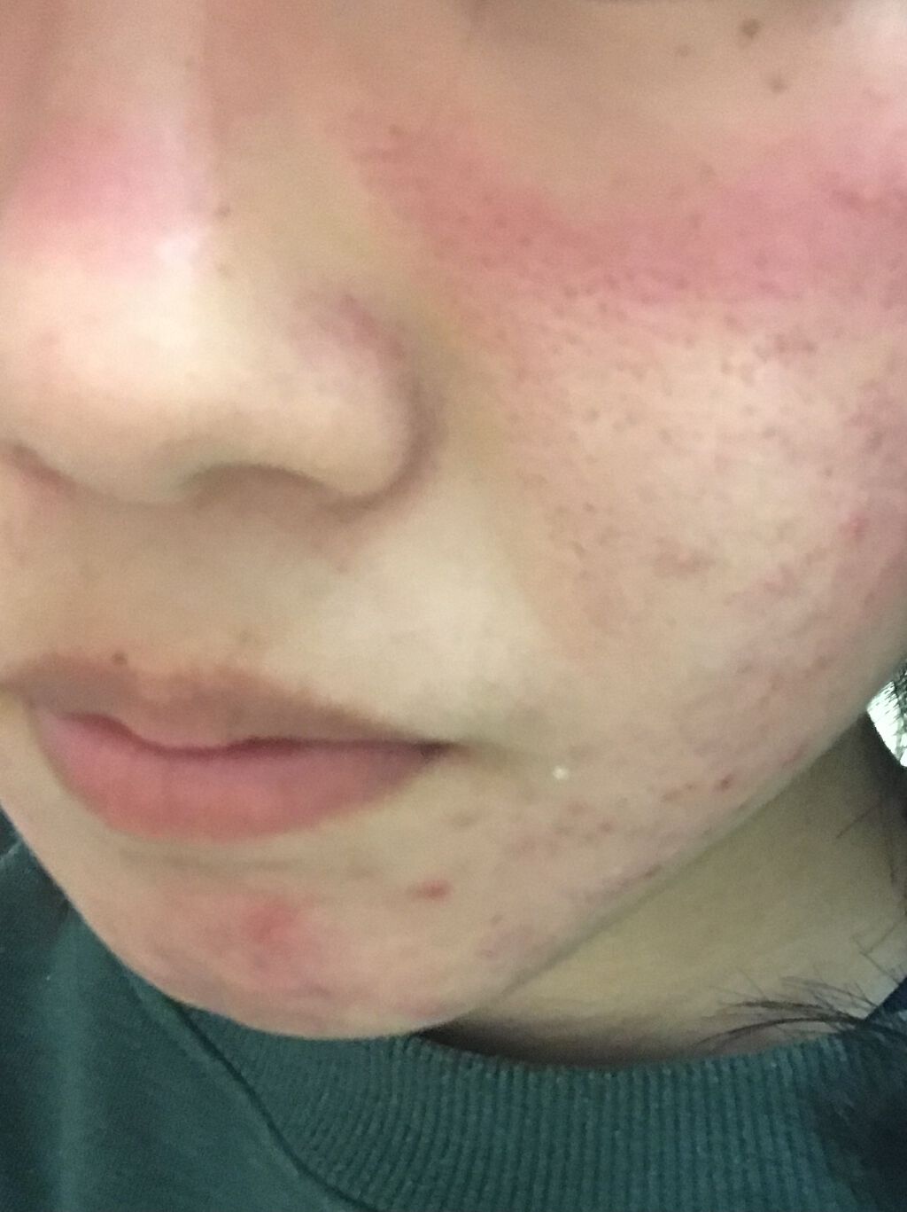 エピデュオゲル/マルホ株式会社/その他を使ったクチコミ（2枚目）