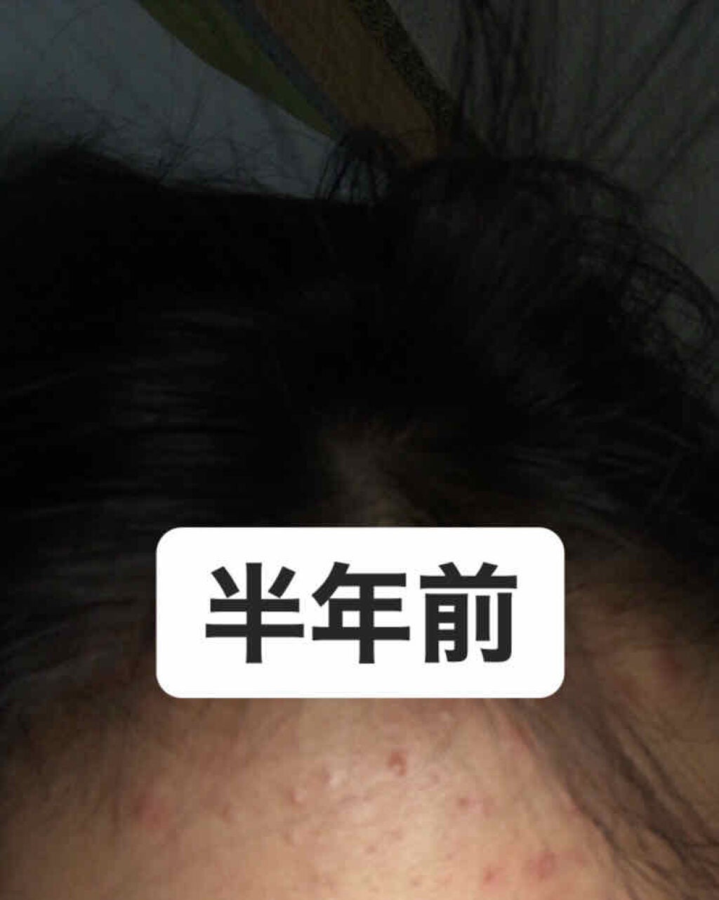 桃 on LIPS 「『⚠️ニキビの肌出てくるので閲覧注意⚠️』〜今に至るまで〜約1..」(3枚目)