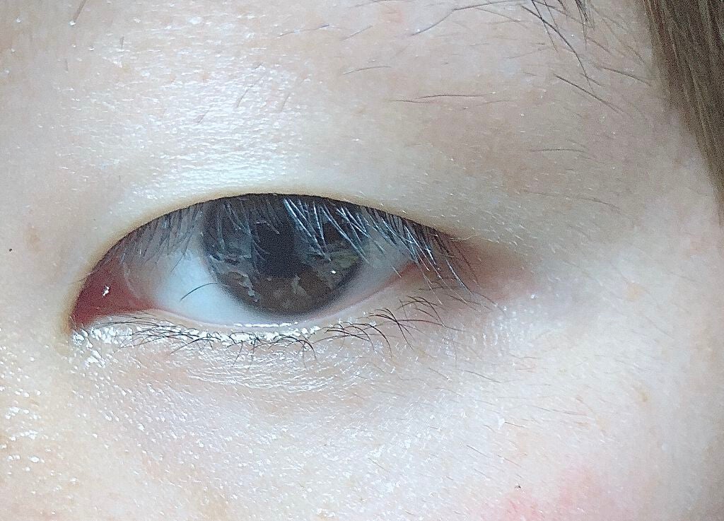 るー on LIPS 「【二重整形について】ついについに…!今日やっと念願であった二重..」(4枚目)