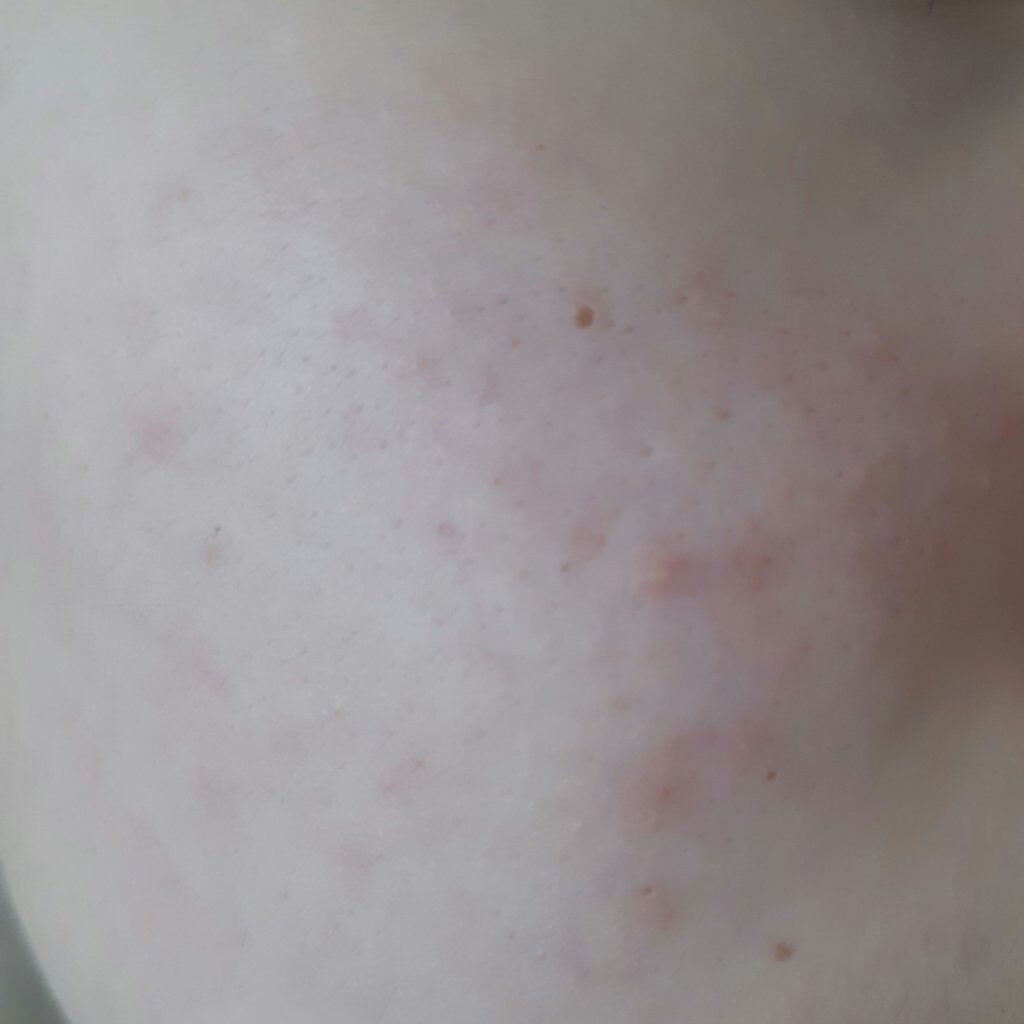 薬用 しみ 集中対策 美容液/メラノCC/美容液を使ったクチコミ（2枚目）