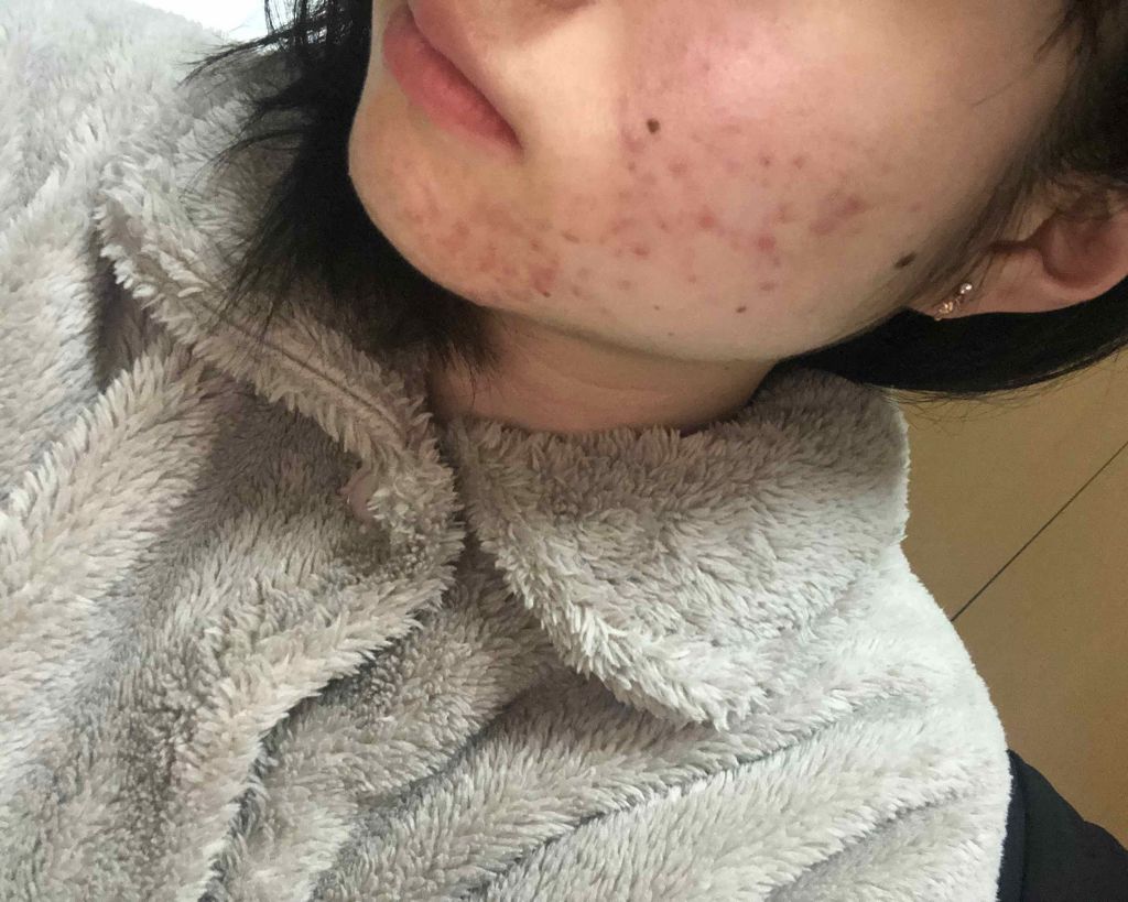 マンスリースキンケアプログラム(旧)/APEX/スキンケアキットを使ったクチコミ(3枚目)