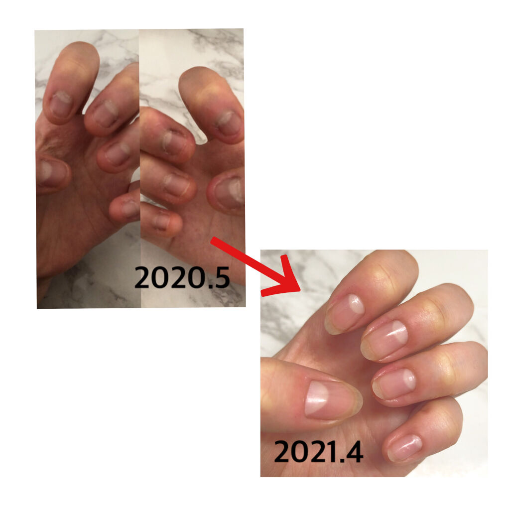 ディープセラム Dr Nailを使った口コミ こんにちは 最近爪が伸びていくのを見ると By Mayuu Lips ディープセラム Dr Nailを使った口コミ こんにちは 最近爪が伸びていくのを見ると By Mayuu Lips