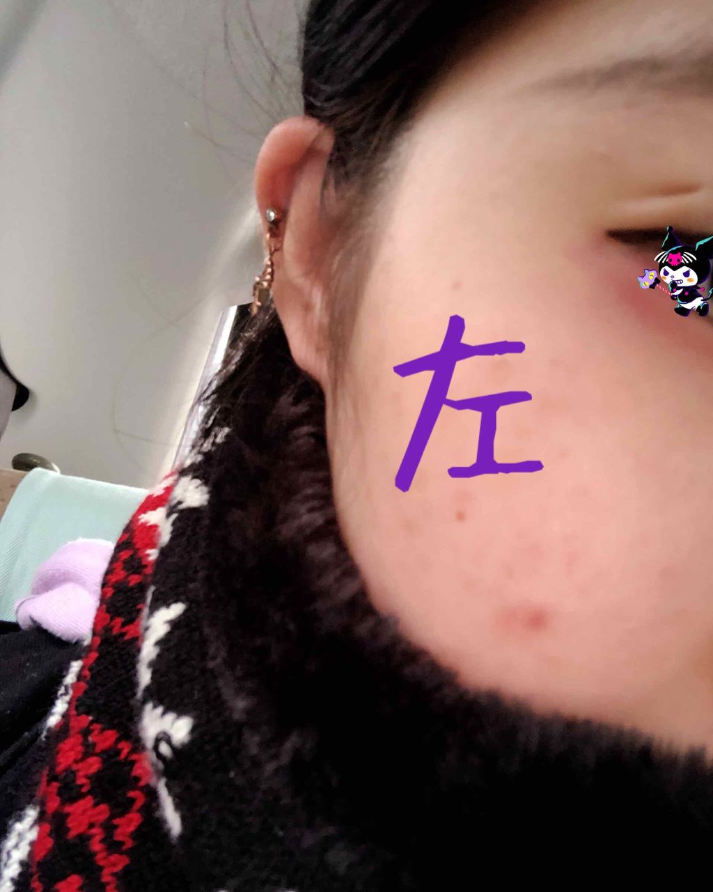Arika on LIPS 「~ニキビを消す方法~⚠️ニキビが消えなくて困ってる人だけ見てく..」(1枚目)