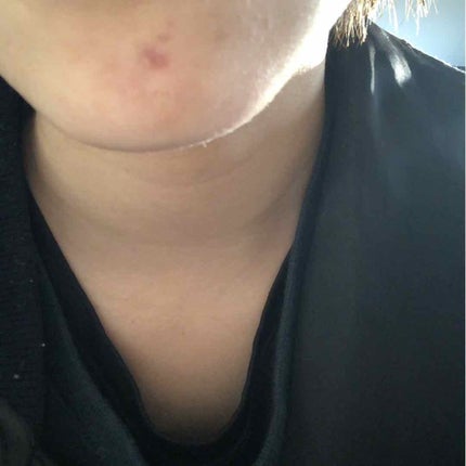 アットノン コンシーラータイプ(医薬品)/アットノン/その他を使ったクチコミ(2枚目)