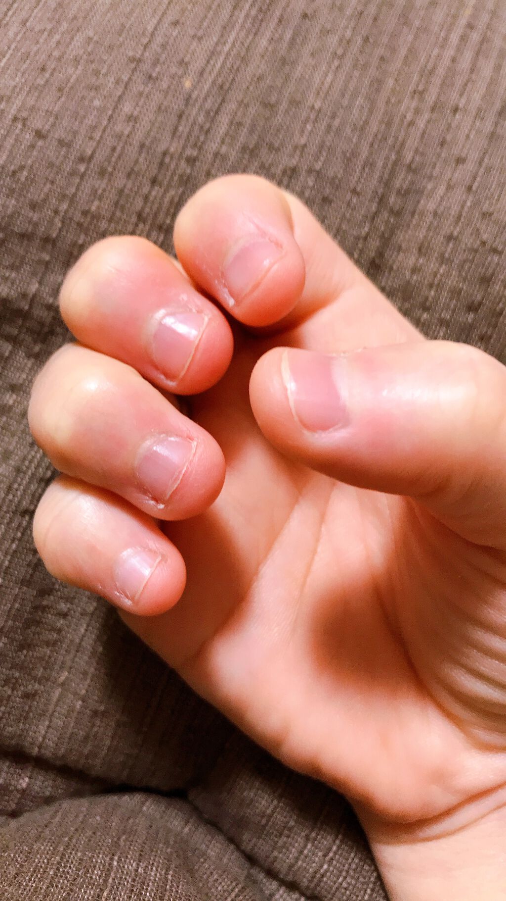 Ettusais ネイルホリックのネイルオイル トリートメントを使った口コミ 小さい頃から爪噛みのくせが抜けず 今は爪を毟るようになってしまい こんな爪に By やんちー 敏感肌 代前半 Lips Ettusais ネイルホリックのネイルオイル トリートメントを使った口コミ 小さい頃から爪噛みのくせが抜けず 今は爪を毟るようになってしまい こんな爪に By やんちー 敏感肌 代前半 Lips