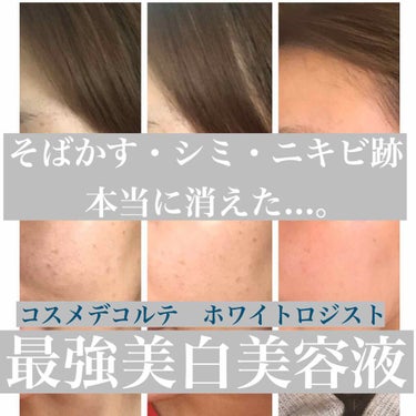 ※写真は使用3ヶ月のビフォーアフターです


■コスメデコルテ
　ホワイトロジスト　ブライトコンセレイト
　40ml 15,000円　詰め替え40ml 14,500円

■私の使用法
　・朝晩　1プッシ