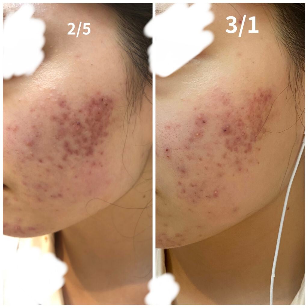 るん on LIPS 「お見苦しい写真で申し訳ないです、、途中経過的な!少し跡が薄くな..」(2枚目)