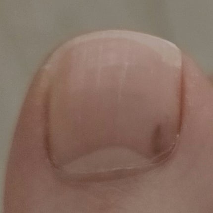 DAISO ガラス爪ヤスリのクチコミ「爪に見覚えのない黒いシミが?
ネットで調べてみるとメラノーマという文字が..
気になったので.....」(2枚目)