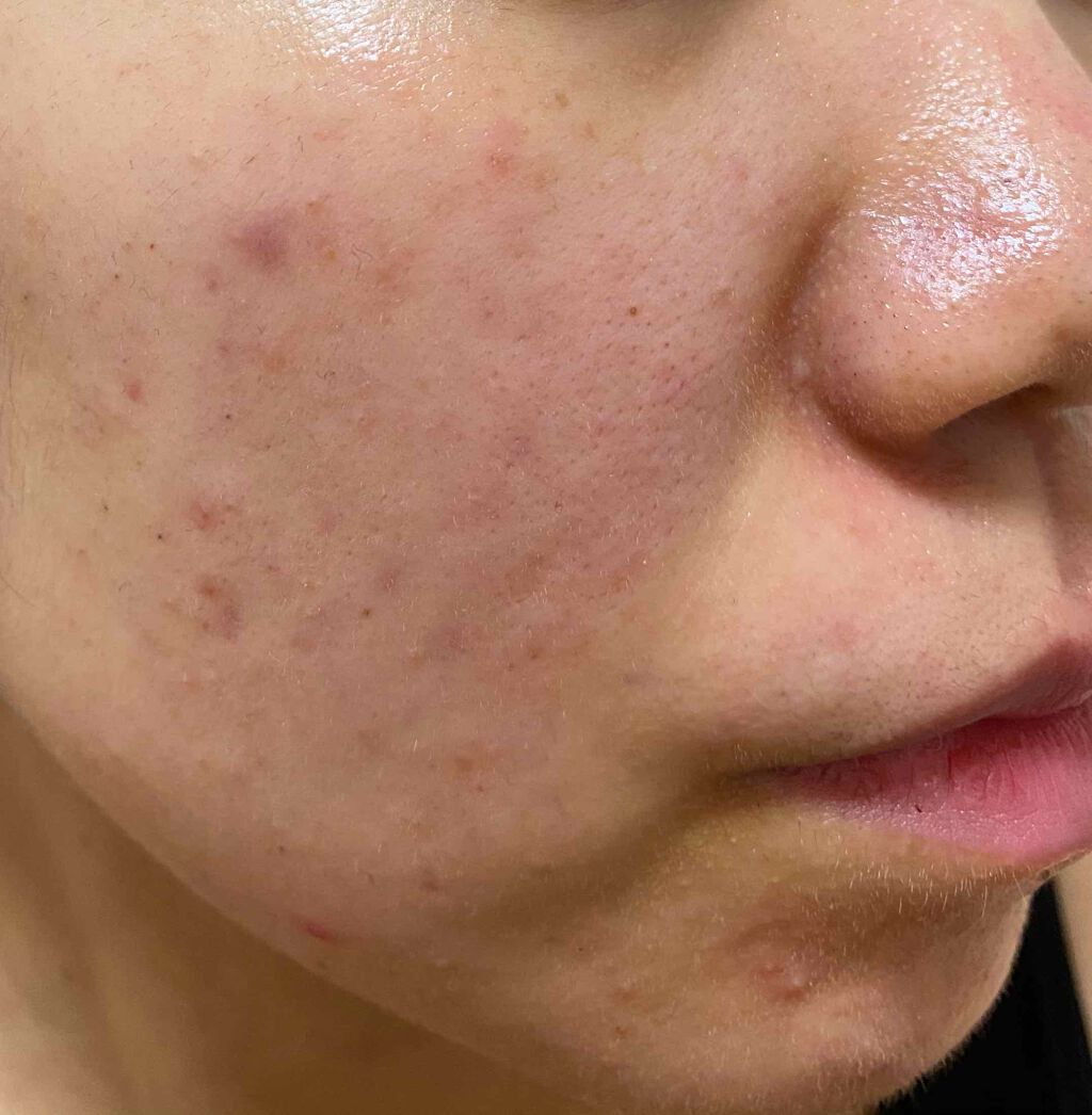 ロゼット洗顔パスタ アクネクリア/ロゼット/洗顔フォームを使ったクチコミ（3枚目）