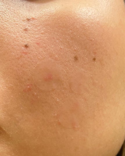 極薄透明パッチ nikipa!/金冠堂/にきびパッチを使ったクチコミ(5枚目)