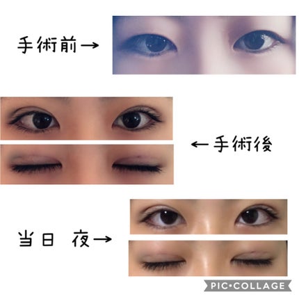 二重整形/その他を使ったクチコミ(2枚目)