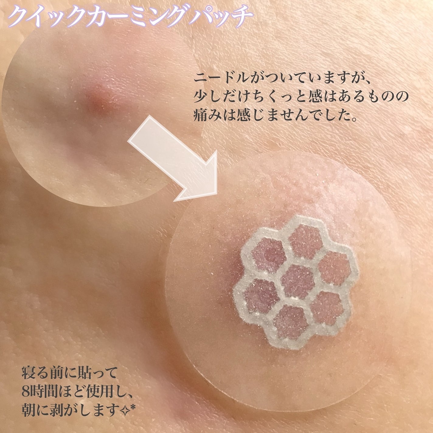 ビューティー スポットパッチ/イージーダムビューティー/にきびパッチを使ったクチコミ(7枚目)