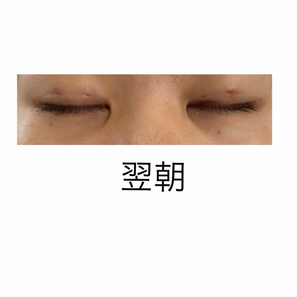 かっこいい女になりたいんだ on LIPS 「手術後の翌朝ん〜ちょっと腫れたかな昨日夜寝る時は熱さまシートを..」(2枚目)