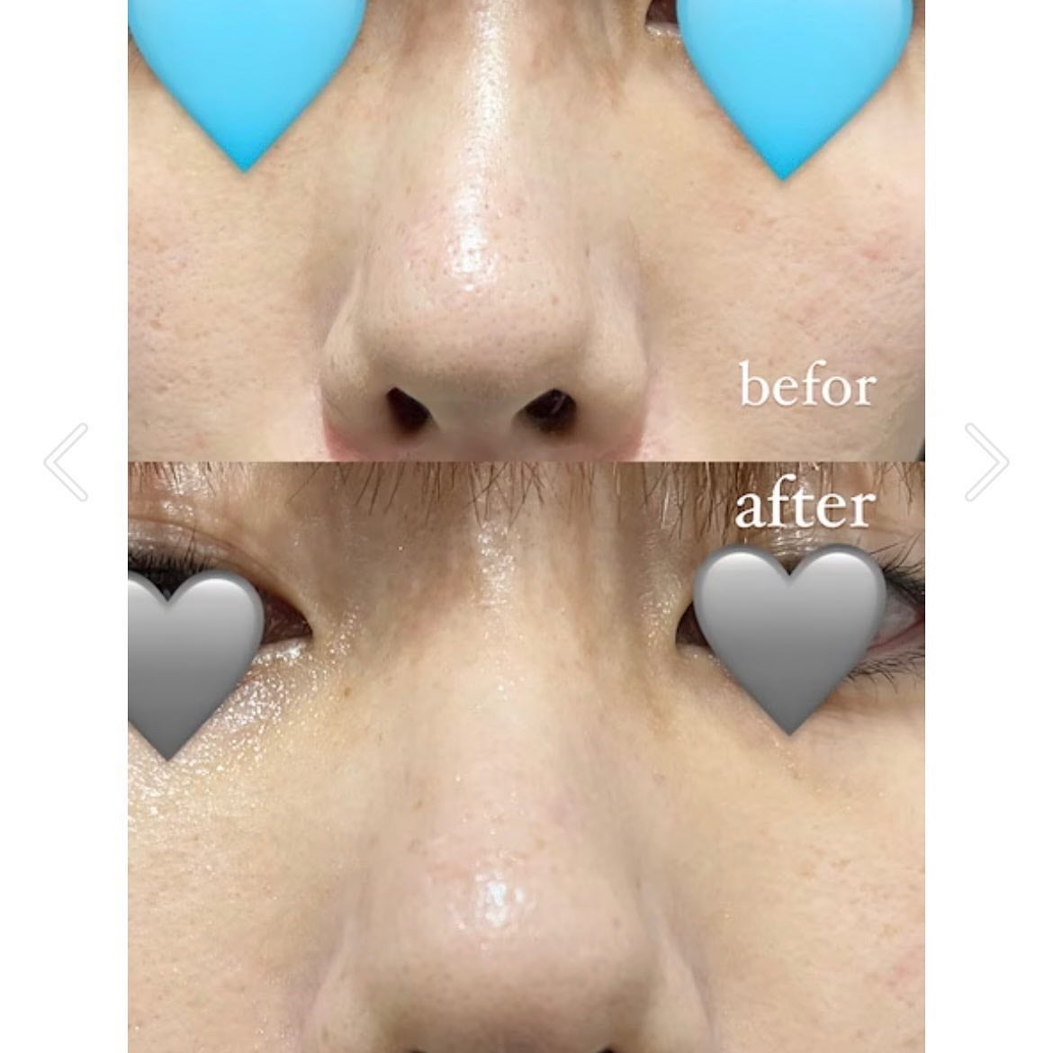 ブラック ヘッド ゼロ 2ステップ ノーズ パッチ/Dr.Althea/シートマスク・パックを使ったクチコミ(2枚目)