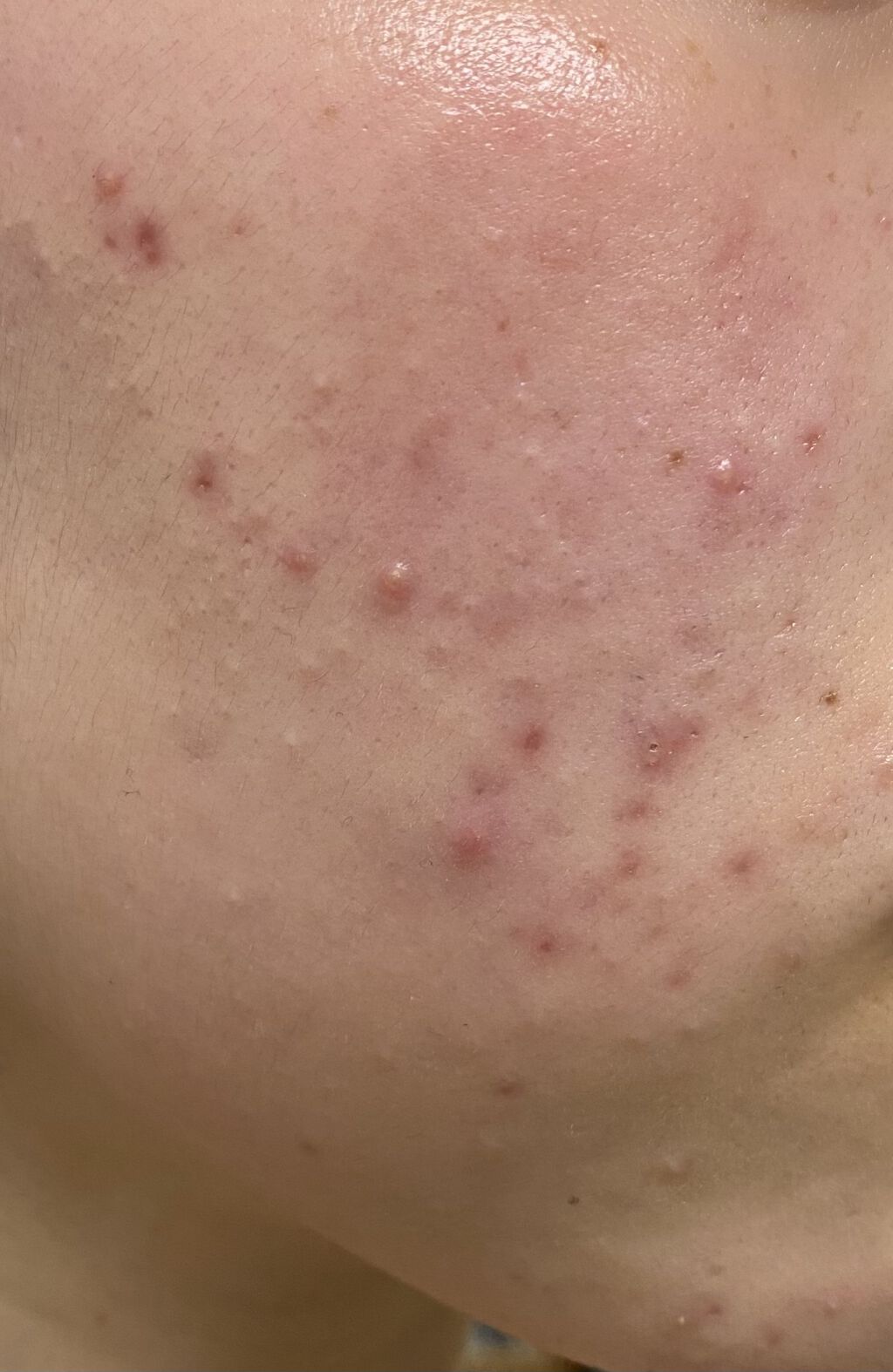 エピデュオゲル/マルホ株式会社/その他を使ったクチコミ（2枚目）