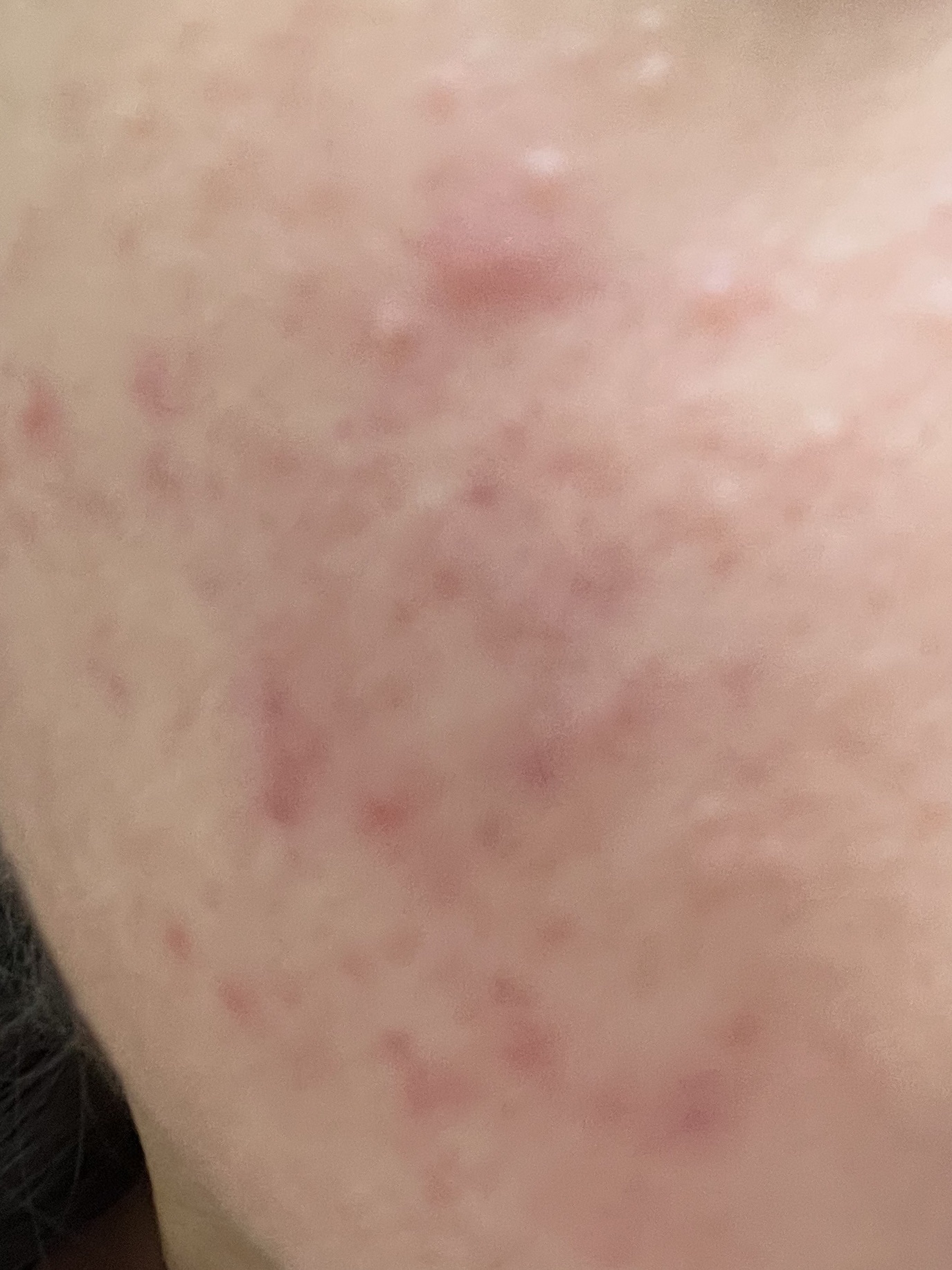 ニキビ治療薬(医薬品)/メンソレータム アクネス/その他を使ったクチコミ（1枚目）