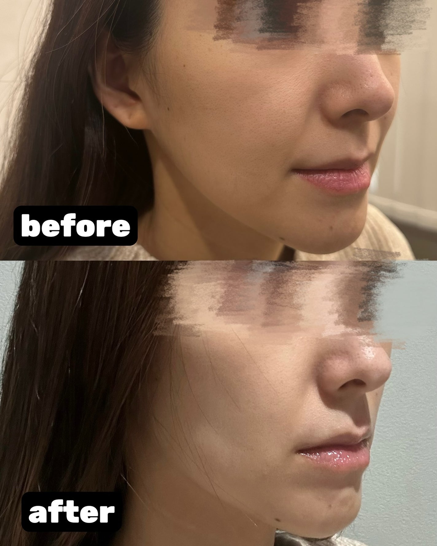 ð»ððððð on LIPS ããã¿ã³ãªããã£ã³ã°ïŒâ¡æ°å¹ŽïŒçºç®çŸå®¹å»çãã¡ããã§ããïŒâ¡ãª..ãïŒ3æç®ïŒ