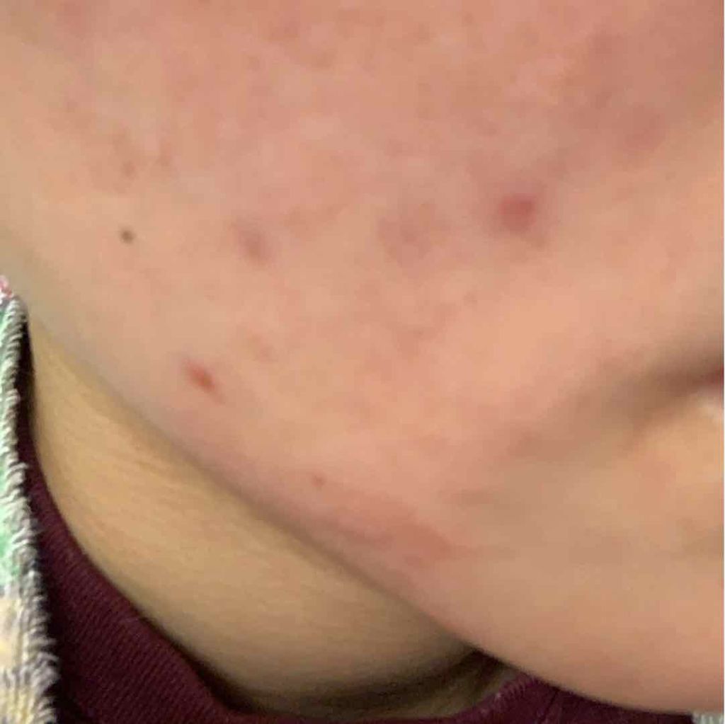 エピデュオゲル/マルホ株式会社/その他を使ったクチコミ（1枚目）