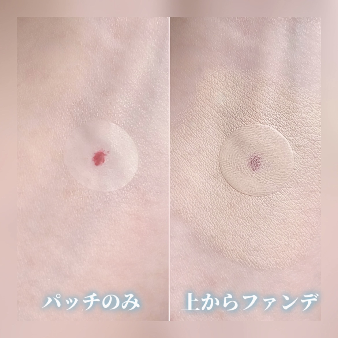 極薄透明パッチ nikipa!/金冠堂/にきびパッチを使ったクチコミ（3枚目）